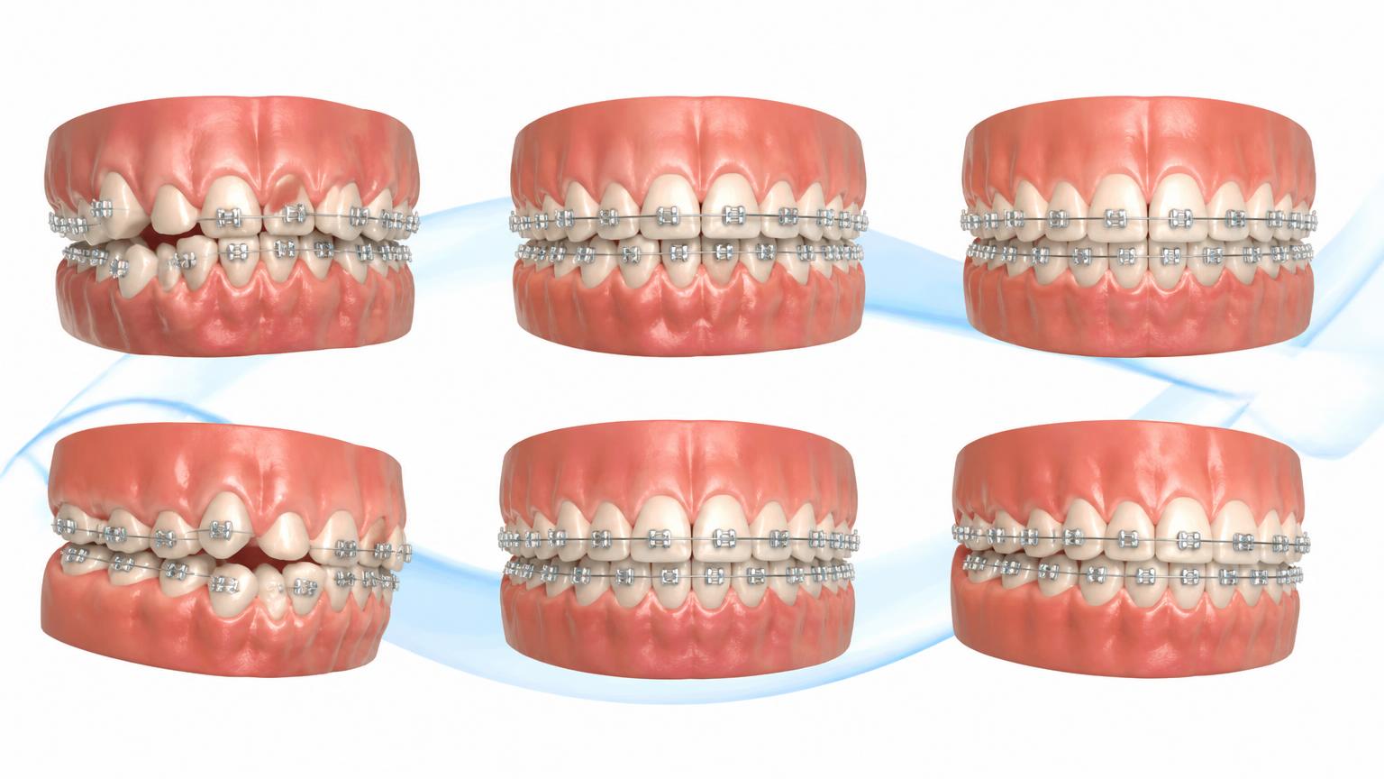 Dental illustration of gradual alignment improvement with braces over several stages