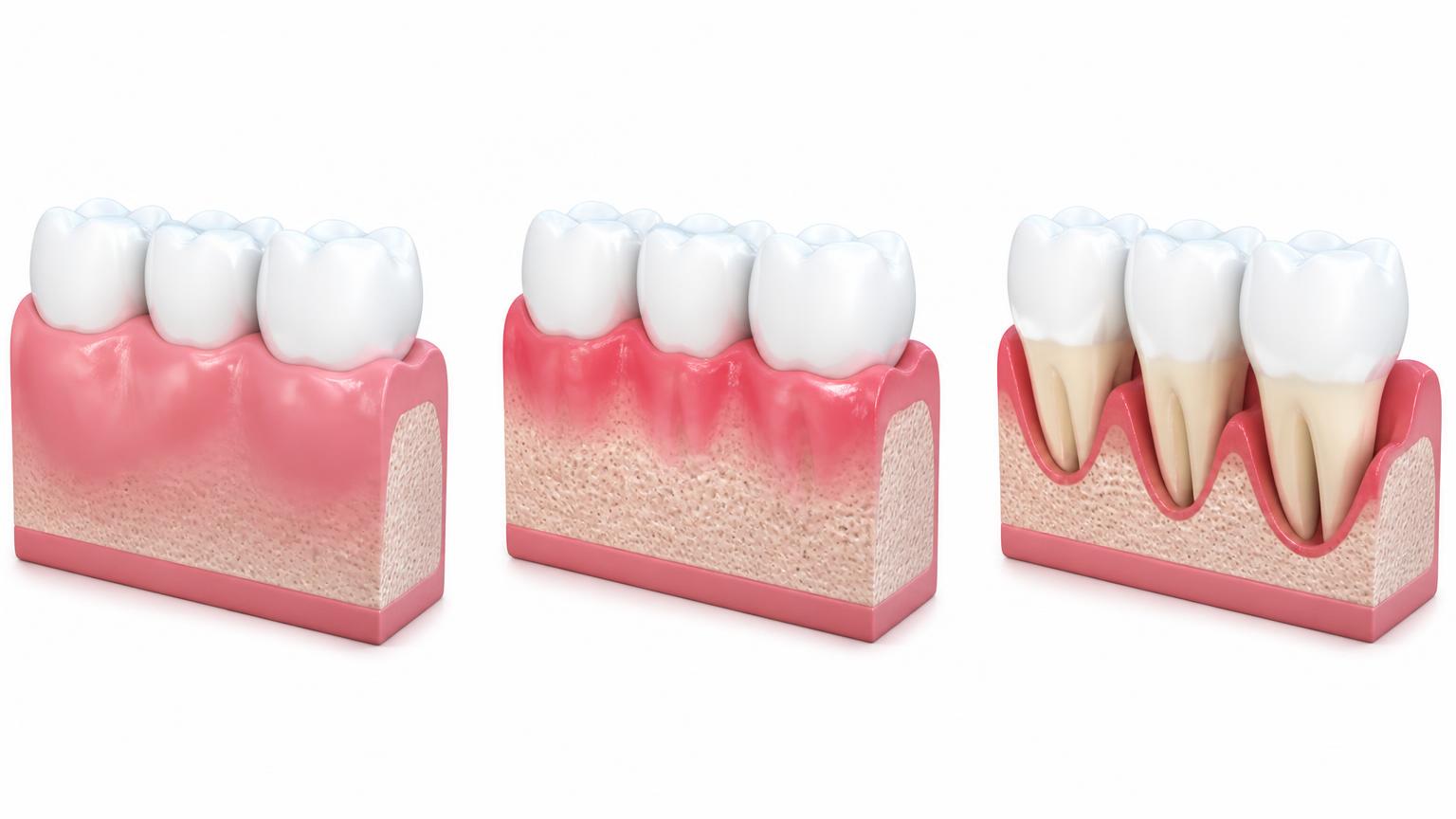 Illustration showing healthy gums, early gum inflammation and more advanced gum disease