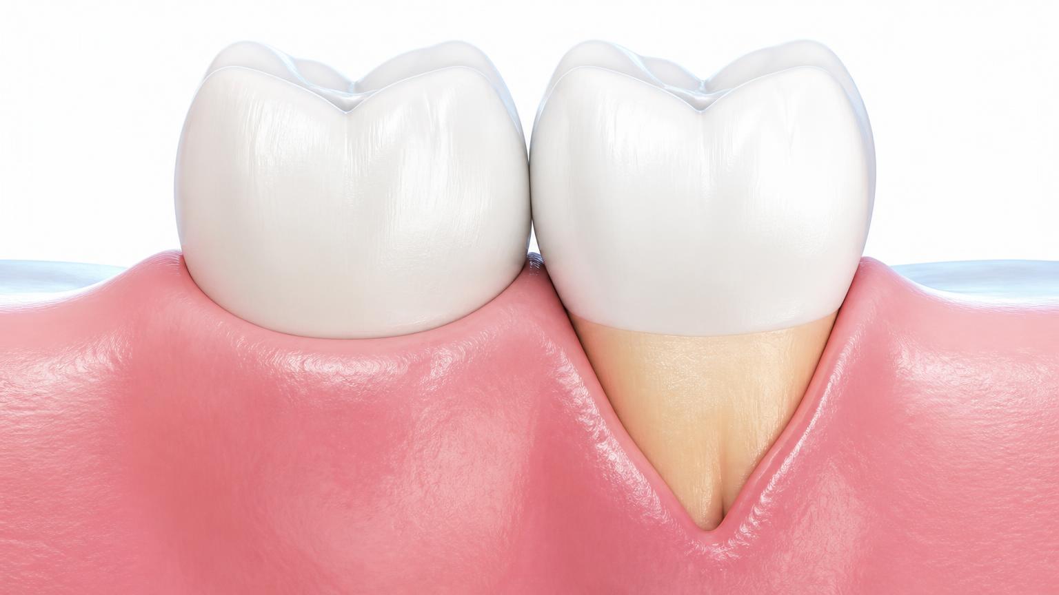 Illustration of a tooth with normal gum position beside a tooth with a receded gum exposing the root