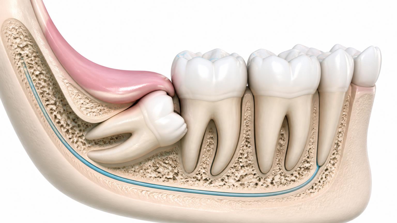 Cross-sectional dental illustration of an impacted lower wisdom tooth beside the second molar