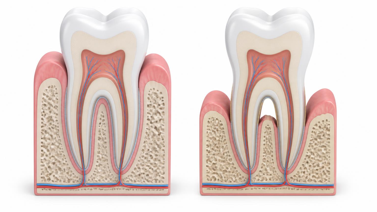 Illustration comparing a firmly supported permanent tooth with a tooth that has reduced gum and bone support