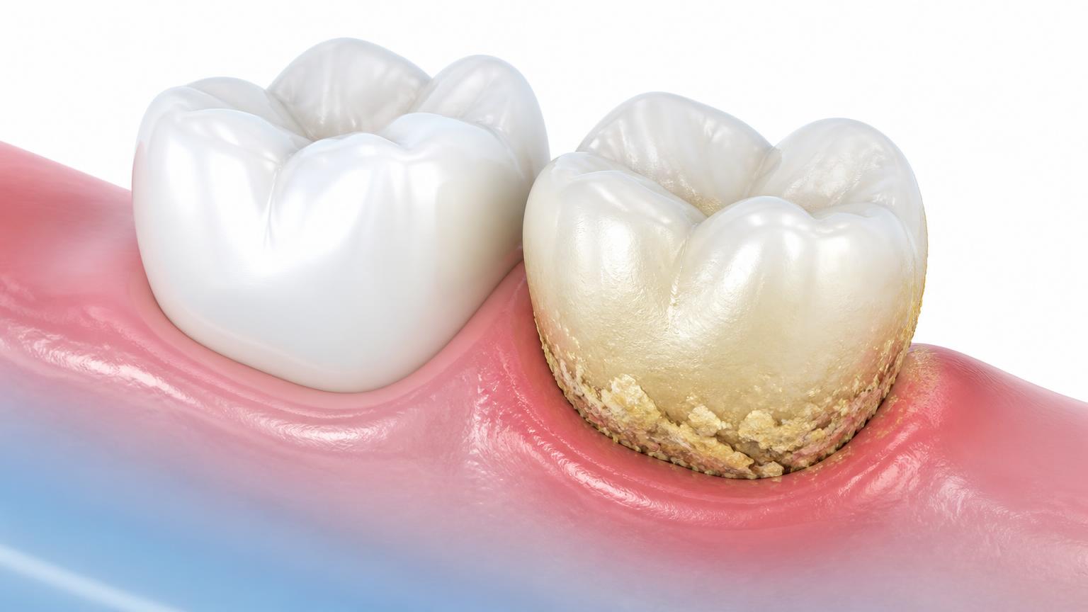 Illustration of a clean tooth beside a tooth with plaque and hardened tartar along the gum line