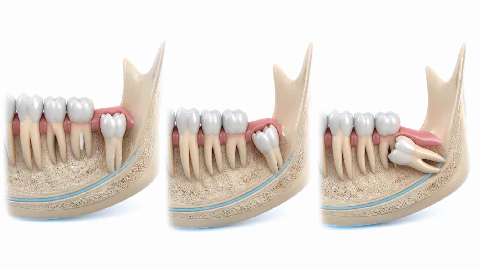 Dental illustration of a fully erupted, partially erupted and deeply impacted wisdom tooth