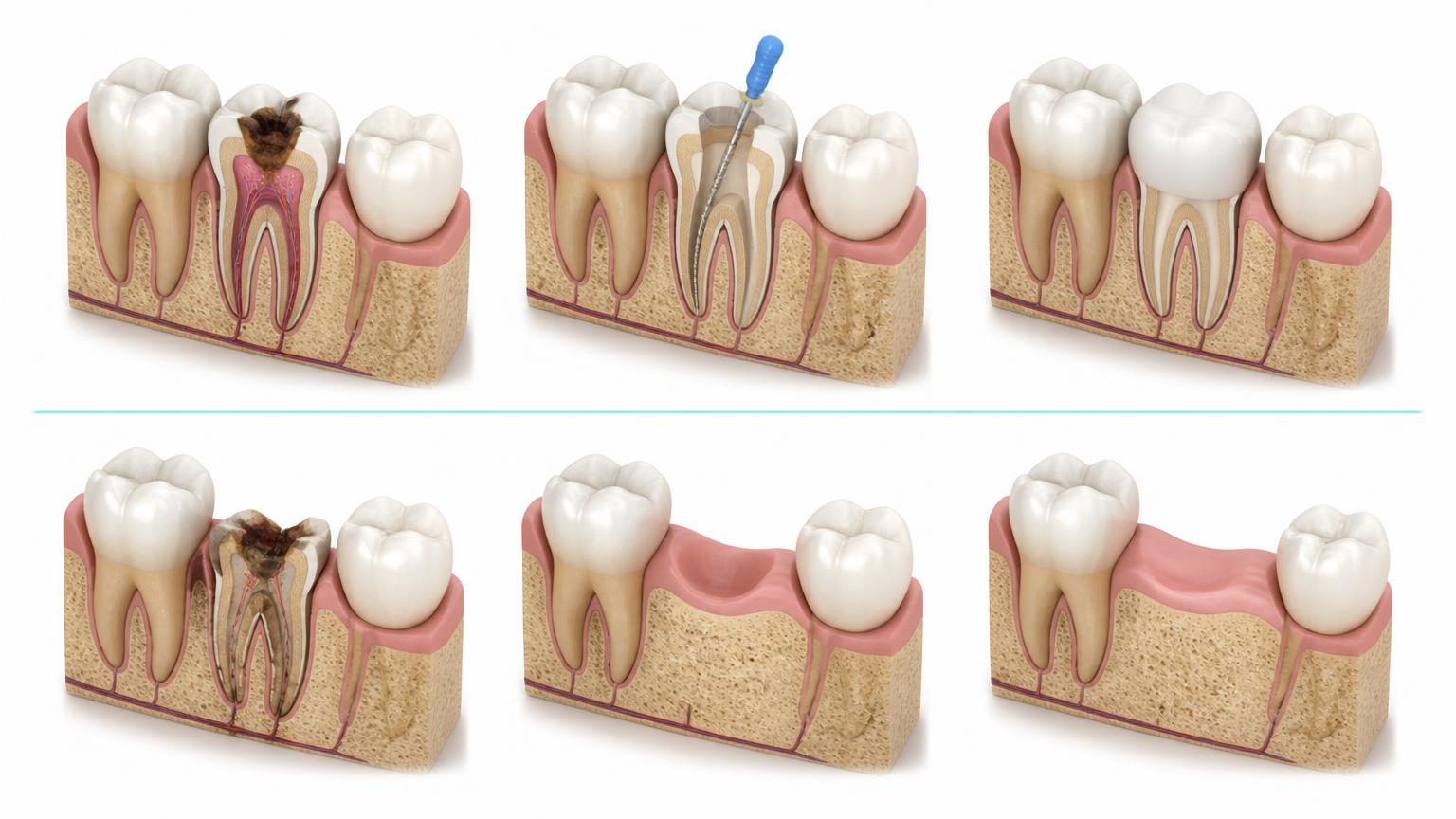Illustration comparing a treated and restored natural tooth with a tooth that could not be restored and was removed