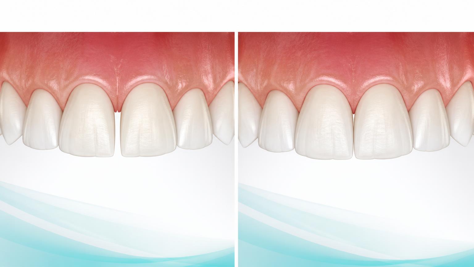 Dental illustration of a small front-tooth gap and a subtle veneer-based improvement