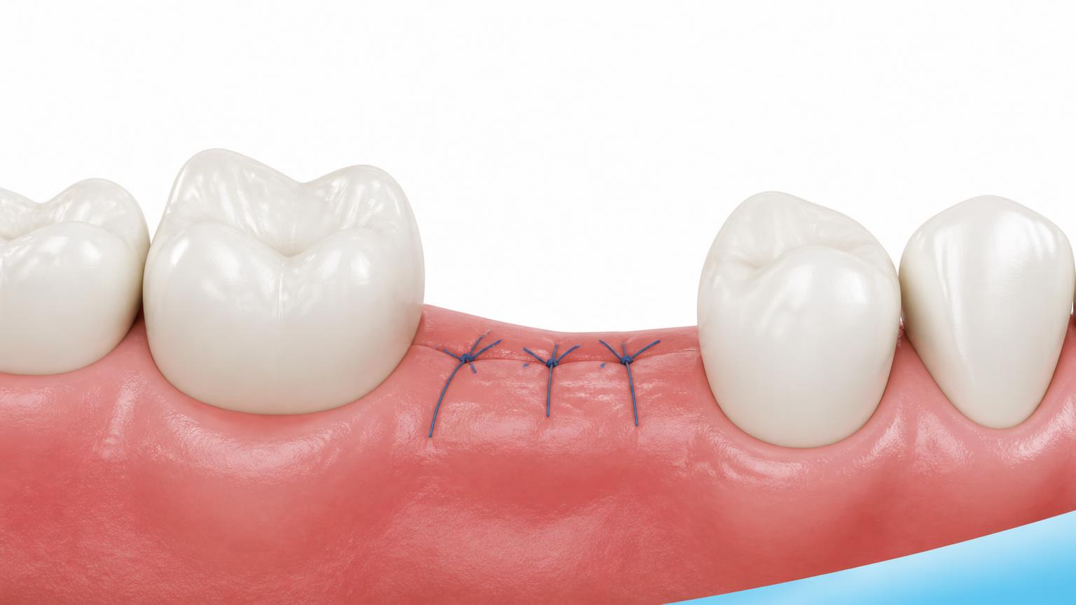 Dental illustration of subtle sutures on a clean gum area after a tooth extraction