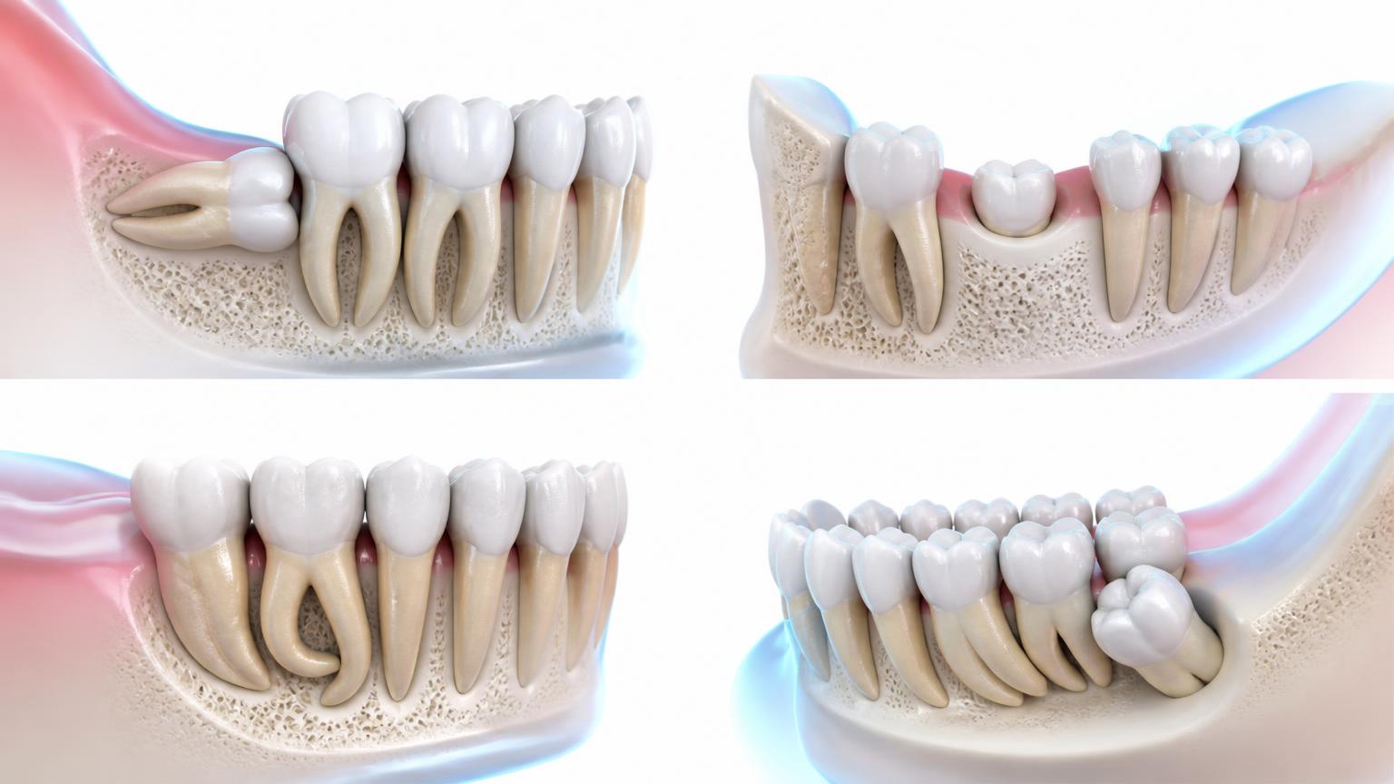 Dental illustration of teeth that may require surgical extraction within an adult jaw