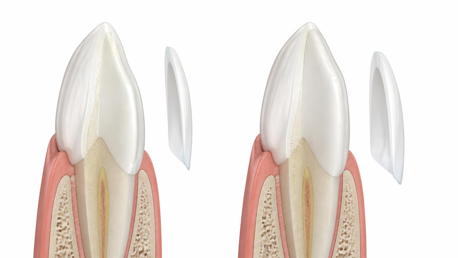 Dental comparison showing different amounts of preparation for veneers
