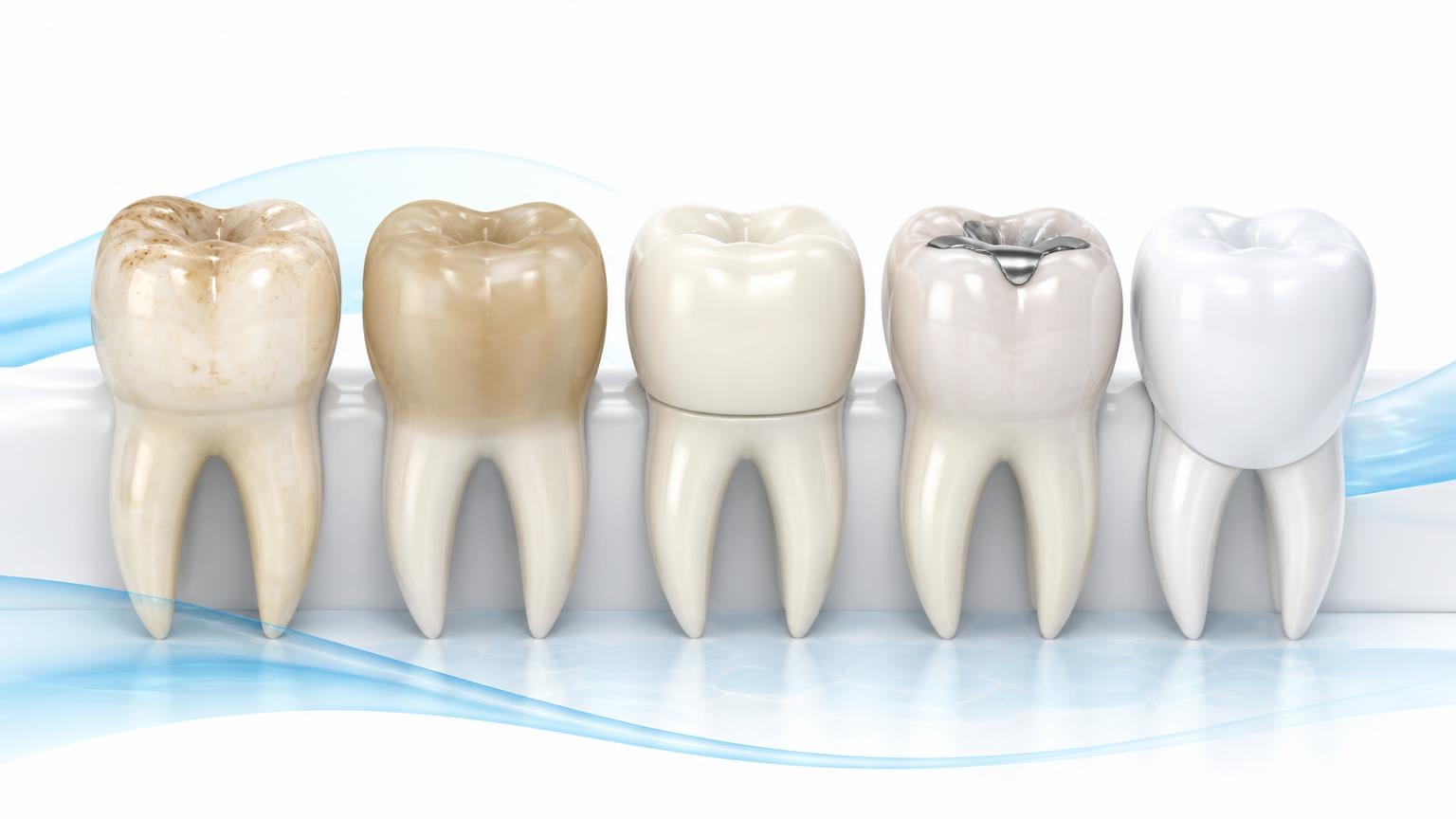 Illustration of teeth with surface staining, deeper discolouration, a crown and a filling shown side by side