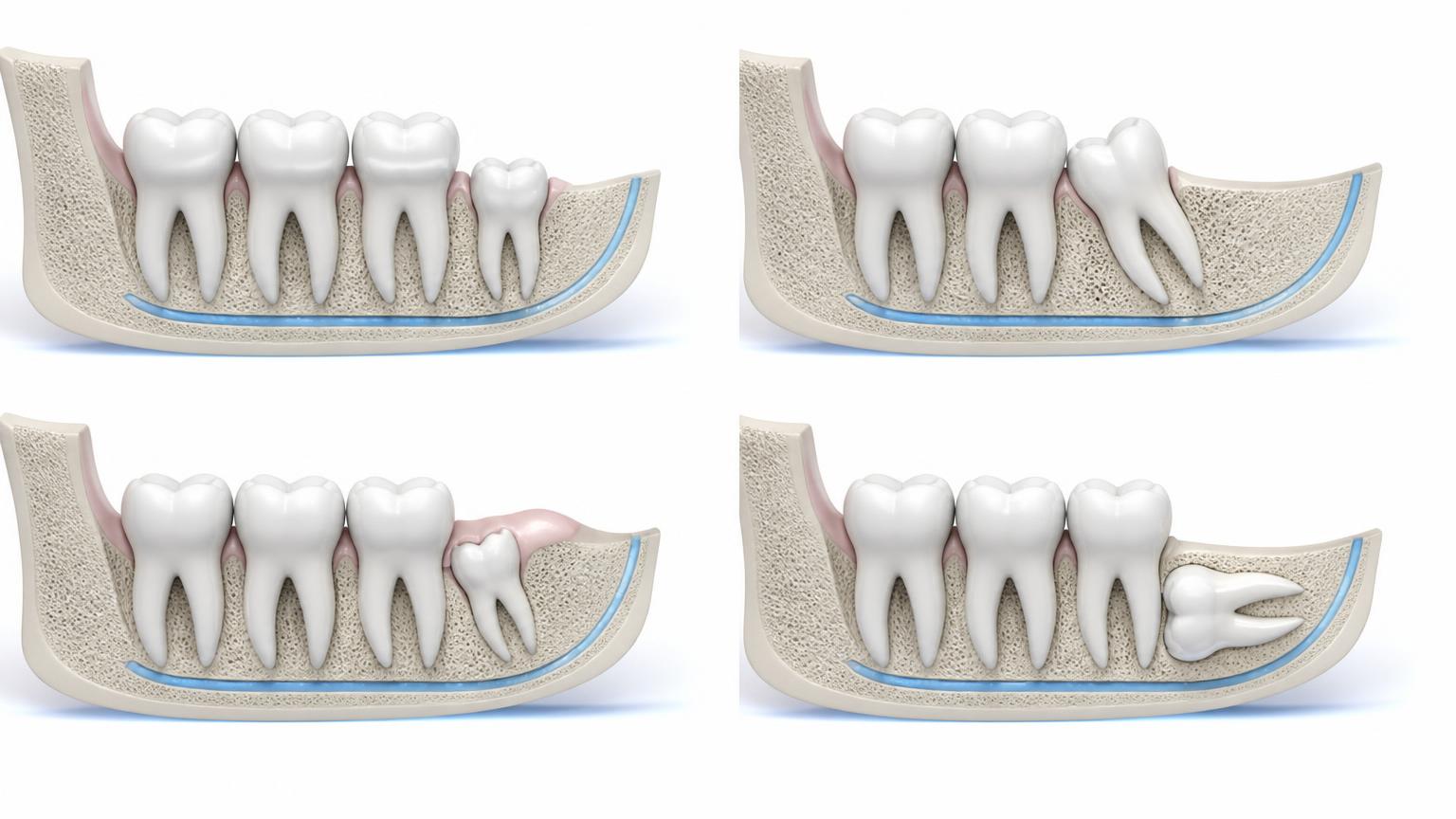 Dental illustration comparing normal, angled, partially erupted and impacted wisdom teeth