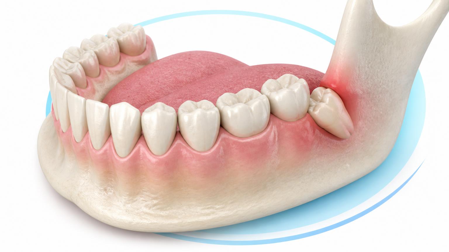 Dental illustration of a lower jaw with mild gum irritation around the back wisdom tooth